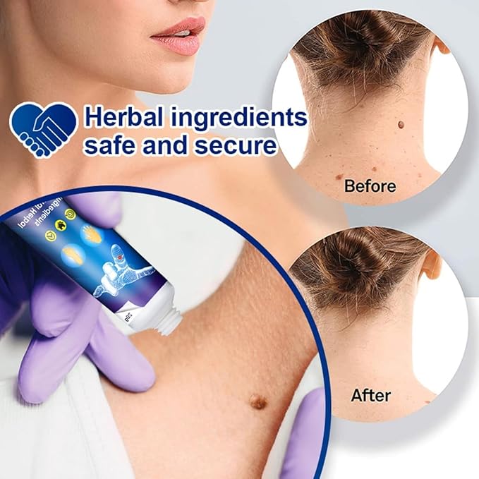Emille Beauty Wart Flat Remover Ointment